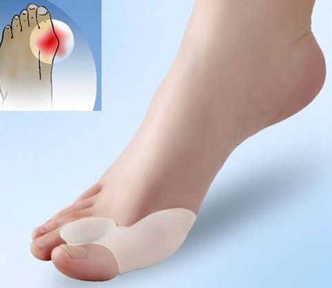 Гелеві накладки Valgus Pro для корекції і комфорту великих пальців стопи (Валгус Про) - 2 штуки 3375273 фото