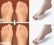 Гелеві накладки Valgus Pro для корекції і комфорту великих пальців стопи (Валгус Про) - 2 штуки 3375273 фото 6